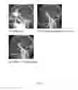 Fig. 06 - METHOD OF CT ANGIOGRAPHY TO VISUALIZE TRANS-OSSEOUS BLOOD VESSELS