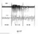 Fig. 07 - Systems and methods for using electrical impedance for neuro cardiac therapy