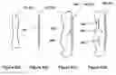 Fig. 06 - Shape and pressure adjustable dressing