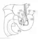 Fig. 01 - Methods for biliary diversion