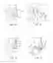 Fig. 05 - Methods for biliary diversion
