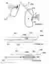 Fig. 03 - Methods for inhibiting renal nerve activity