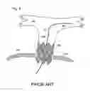 Fig. 04 - GUIDEWIRE WITH ANCHOR