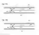 Fig. 11 - GUIDEWIRE WITH ANCHOR