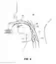 Fig. 04 - VACUUM ASSIST DEVICE TO REMOVE OBJECT FROM TRACHEA