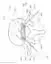 Fig. 14 - Electrosurgical tissue treatment method