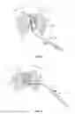 Fig. 04 - Multipolarity epicardial radiofrequency ablation