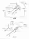 Fig. 16 - METHODS AND DEVICES FOR TREATING TISSUE