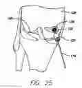 Fig. 14 - Method and device for ameliorating joint conditions and diseases