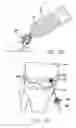 Fig. 16 - Method and device for ameliorating joint conditions and diseases