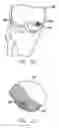 Fig. 18 - Method and device for ameliorating joint conditions and diseases