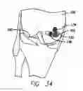 Fig. 19 - Method and device for ameliorating joint conditions and diseases
