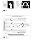 Fig. 05 - Methods and devices for patient-specific acetabular component alignment in total hip arthroplasty