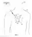 Fig. 02 - Implantable medical device fixation