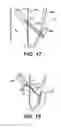 Fig. 09 - Implantable tissue fastener and system for treating a gastrointestinal tract