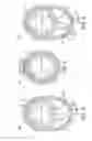 Fig. 04 - Rotational atherectomy device with fluid inflatable support elements and two torque transmitting coils