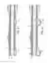Fig. 35 - Rotational atherectomy device with fluid inflatable support elements and two torque transmitting coils