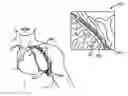 Fig. 01 - Lung volume reduction devices, methods, and systems