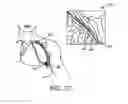 Fig. 03 - Lung volume reduction devices, methods, and systems