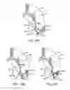 Fig. 31 - Lung volume reduction devices, methods, and systems
