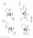 Fig. 43 - Lung volume reduction devices, methods, and systems