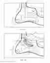 Fig. 03 - Method of dilating tissue of a sinus drainage pathway