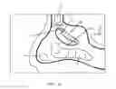 Fig. 04 - Method of dilating tissue of a sinus drainage pathway