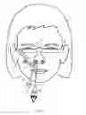 Fig. 11 - Method of dilating tissue of a sinus drainage pathway