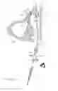 Fig. 21 - Method of dilating tissue of a sinus drainage pathway