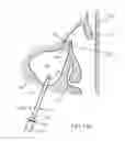 Fig. 25 - Method of dilating tissue of a sinus drainage pathway