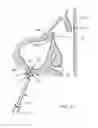 Fig. 30 - Method of dilating tissue of a sinus drainage pathway