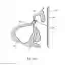 Fig. 37 - Method of dilating tissue of a sinus drainage pathway