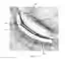 Fig. 41 - Method of dilating tissue of a sinus drainage pathway