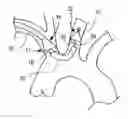 Fig. 01 - Method of isolating the cerebral circulation during a cardiac procedure