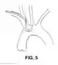 Fig. 10 - Method of isolating the cerebral circulation during a cardiac procedure