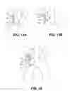 Fig. 19 - Method of isolating the cerebral circulation during a cardiac procedure
