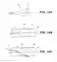 Fig. 23 - Method of isolating the cerebral circulation during a cardiac procedure