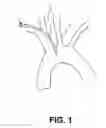 Fig. 02 - Steerable dual filter cerebral protection system
