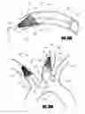 Fig. 41 - Steerable dual filter cerebral protection system
