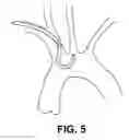 Fig. 10 - Method of accessing the left common carotid artery
