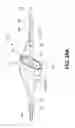 Fig. 32 - Method of accessing the left common carotid artery