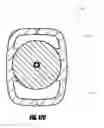 Fig. 61 - Method of accessing the left common carotid artery
