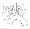 Fig. 01 - Aortic embolic protection device