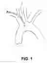 Fig. 02 - Aortic embolic protection device