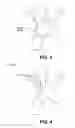 Fig. 09 - Deflectable intravascular filter