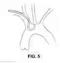 Fig. 10 - Deflectable intravascular filter