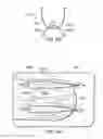 Fig. 07 - Suture