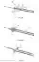 Fig. 06 - Implanted medical device useful for cosmetic surgery
