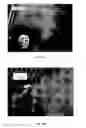 Fig. 31 - Implanted medical device useful for cosmetic surgery