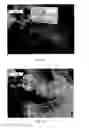 Fig. 32 - Implanted medical device useful for cosmetic surgery